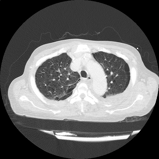 ct_chest_anemia_05